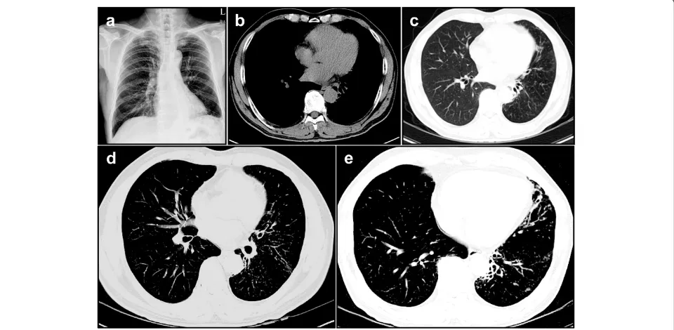 Fig. 2 Serial chest imaging findings in M. lentiflavum-infected patient. At 12 month follow-up, chest imaging studies revealed that the previouslesions in both lungs were improved remarkably (a-c)