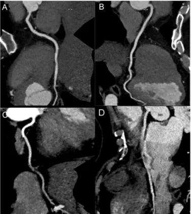 Figure 2. Subjec ve image quality was evaluated using a 4-point scale: 1 = excellent, no ar facts (A); 2 = good, minor ar facts (B); 