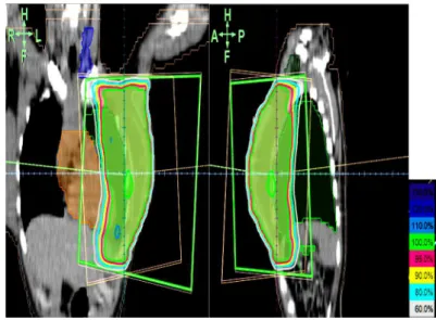 Figure 1. Isodose distribu ons in coronal images  for right breast mastectomy pa ents without          