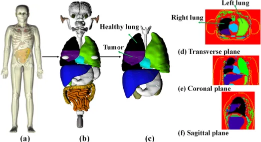 Figure 1. The implementa on of lung cancer NSCLC model in the CHRP-Male 30 phantom, and the three views of NSCLC model
