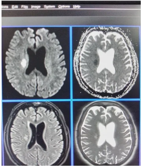 Fig. 4: Subacute infarct with hem transformation.  Faint.  