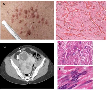 Figure 1 (fibers with a centrally located long, blunt-edged nucleus. (hematoxylin and eosin, [H&e] 10A–E) Clinical manifestations of hereditary leiomyomatosis and renal cell carcinoma (HLRCC): leiomyomas