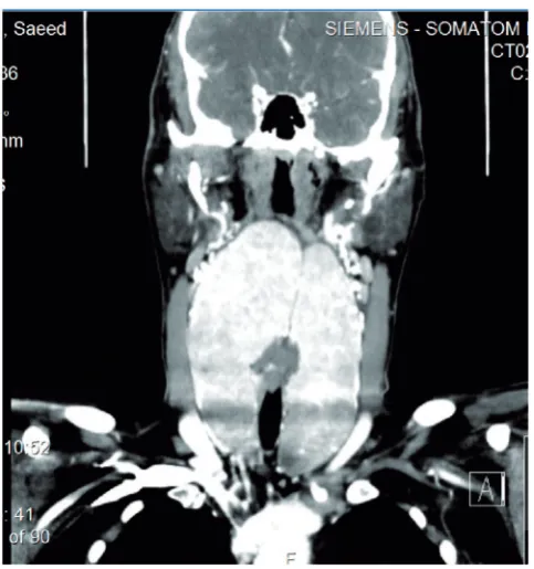 Fig. 1. Coronal section CT scan showing the extension of the mass.
