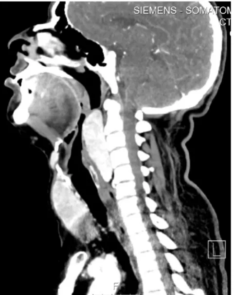 Fig. 2. Axial cut CT scan showing thyroid encasing the trachea.