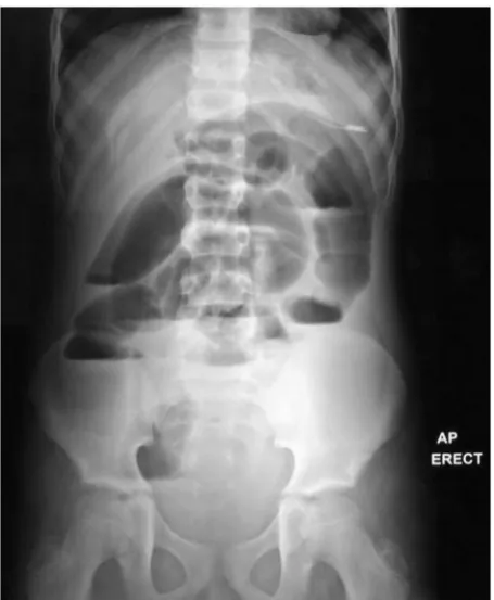 Fig. 3. Supine abdominal radiograph on the fourth postoperative day, no changes.