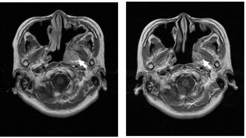 Fig. 6. Chest CT scan. Lung metastatic tumor size decreased after the initial course of chemotherapy (left); however, itgradually increased during 6 courses of chemotherapy (right).