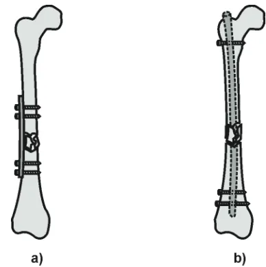 Fig. 1. Solutions for fractures of long bones. a) Neutralization plate.; b) Intramedullary nail