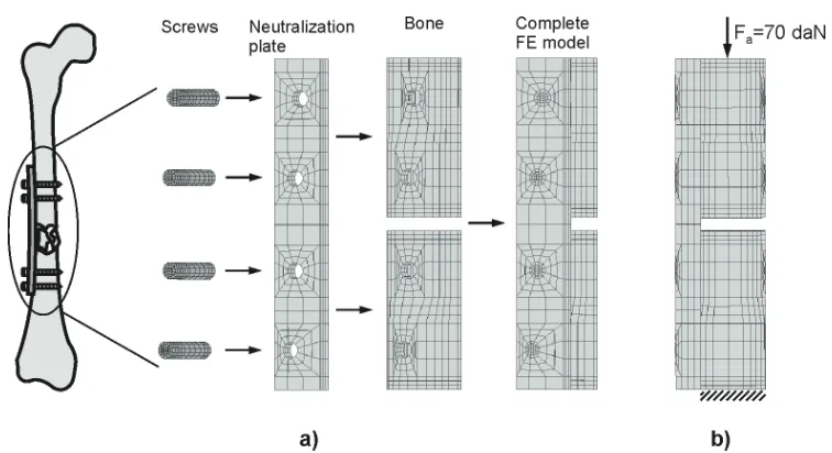 Fig. 2. a) Finite element model of femur comminuted fracture fixed by neutralization plate