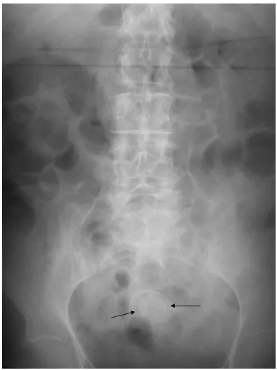 Fig. 1. Abdominal radiograph. Gas is shown in the biliary tract. There are dilated bowel loops and a radio-opaque stone is visiblein the pelvis (arrows).