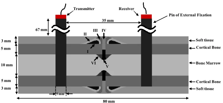 Fig. 1. The 2D model of a healing bone in which the external fixation pins and the transmitter-receiver are also shown