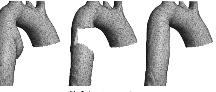 Fig. 2. Aneurism removal. 