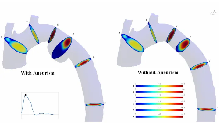 Fig. 4. Velocity profile for a peak systole phase for Case I (aorta with aneurysm) and Case II (aorta without aneurysm) 