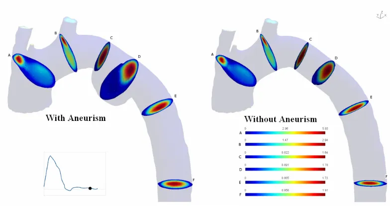Fig. 6. Velocity profile for a diastole phase for Case I (aorta with aneurysm) and Case II (aorta without aneurysm) 