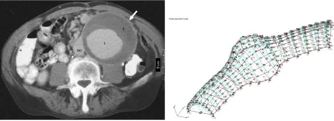 Fig. 1.  a)  Cross sectional CT image of the abdomen showing a large Abdominal Aortic Aneurysm b) Typical finite element mesh of an artery with an aneurysm