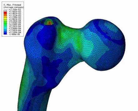 Figure 11. The maximum principal strain distribution around a 13mm diameter hole, located at the greater trochanter (position 2)