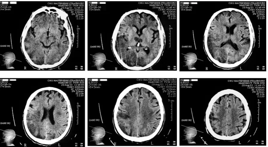 Fig. 1. Structural MRI of the patient (day 4) demonstrates multiple hypodense areas in the right perisylvian region,additional smaller bilateral ischaemic areas in the parietal and occipital lobes, as well as bithalamic lesions