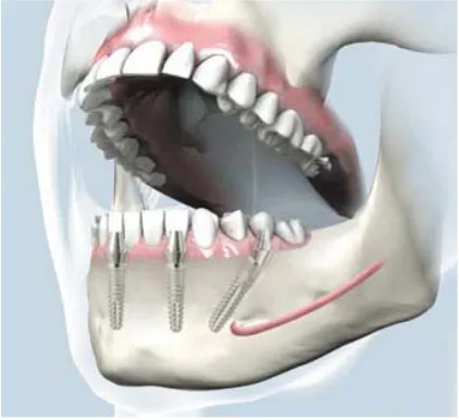 Fig. 1. Orientation of typical implant within the jawbone 