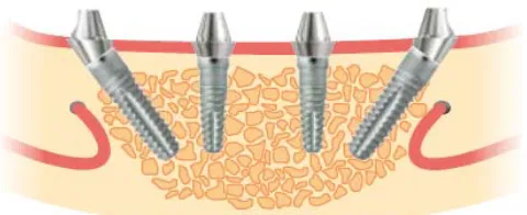 Fig. 3. Cross-section view of SKY implant in the lower jaw 