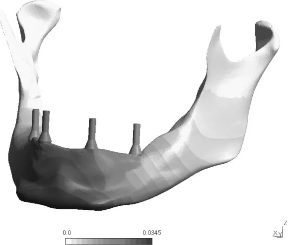 Fig. 9. Effective stress distribution (units MPa) at the implant-bone interfacecompressive loading configurations