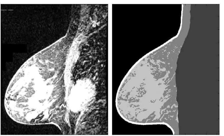 Fig. 1. Comparision of the initial picture and the segmented one (dense tissue, fat and fibrous tissue, skin) 