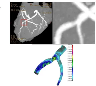 Fig. 8. LAD distal segment for patient angiography images and shear stress distribution