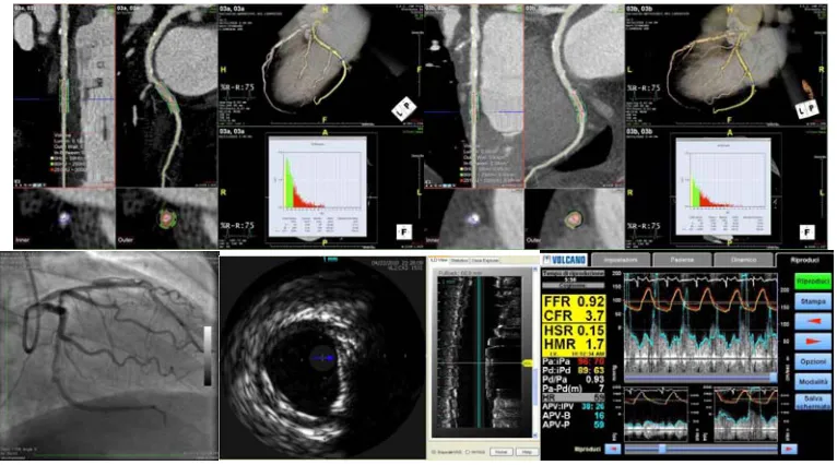 Fig. 10. LDL distribution for baseline and follow- up study after 6 months for coronary artery segment in the patient #5