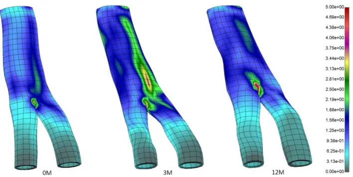 Fig. 5. Effective wall stress calculated for follow-up time baseline, three and six month for patient #1 (units 1 = 1e5 Pa) 