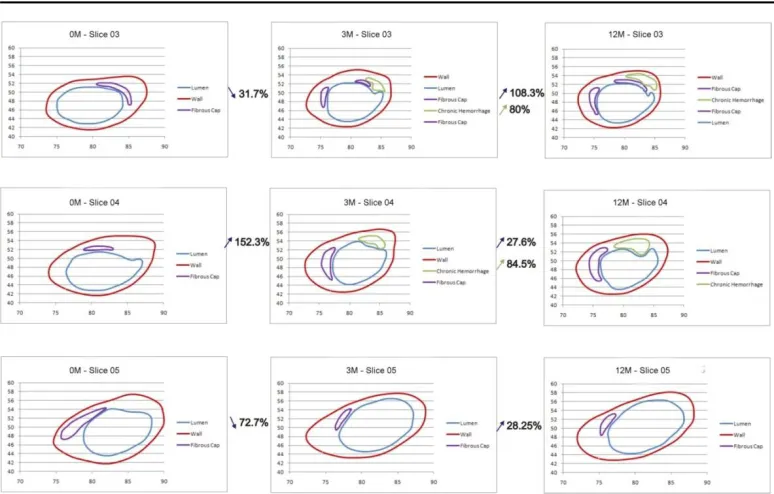 Fig. 4b. 3D presentation of plaque composition and different material properties for patient #1 