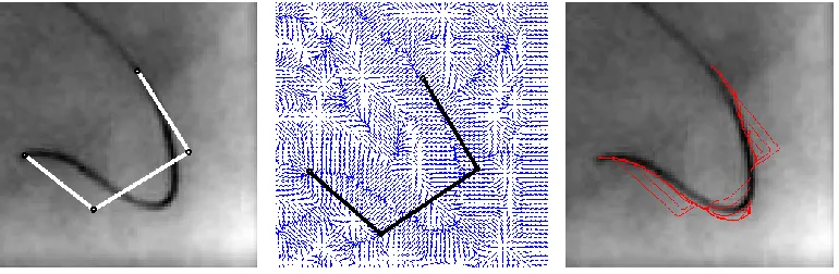 Fig. 1. Initialization, GVF, and evolution of snake over angio image 