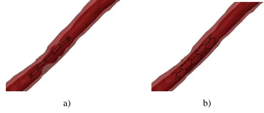 Fig. 2. Stent positioning before (a) and after (b) stent deployment presented in Fig. 2