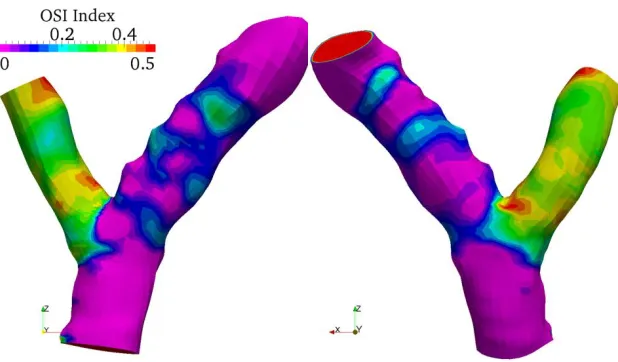 Fig. 5. Oscillatory Shear Index (OSI) for observed patient-specific case.  