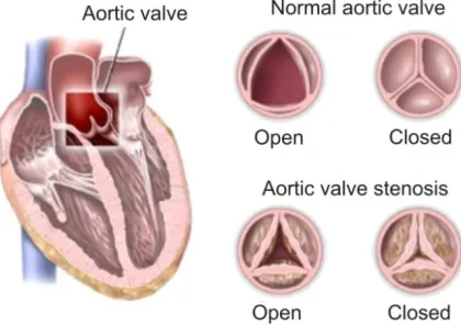 Fig. 1. Cross-sections of a normal aortic valve and a stenotic aortic valve 