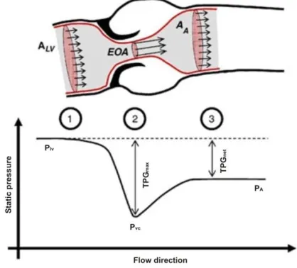 Fig. 2. Schematic representation of aortic stenosis with characteristic cross-sections 