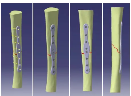 Fig. 14. Creation of customized the contour of the proximal part of the fixation; (b) Creating the intersecting contour curve; (c) dynamic fixator for tibia according to Mitković