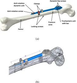 Fig. 9. An assembly containing geometrical models of femur and SIF. (a) Assembly components; (b) Main design parameters 