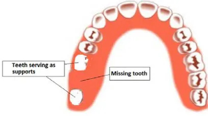 Fig. 2. Bridge in zirconia. 