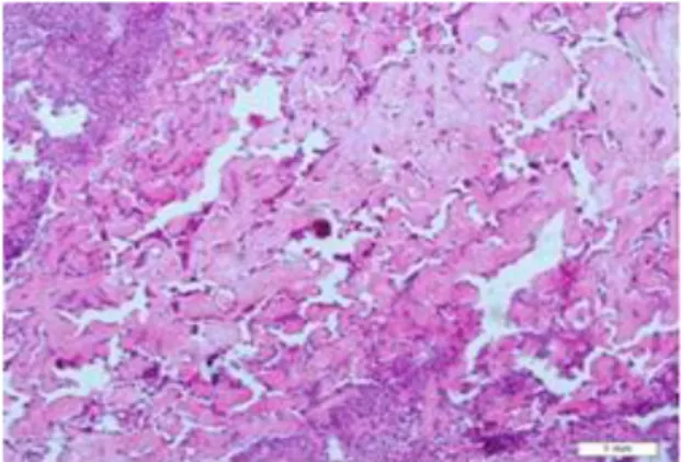 Figure  6.  Extensive  hyalinization  and  areas  of  calcification  close  to  the  malignant  cells  (Hematoxylin-Eosin, original magnification ×100)