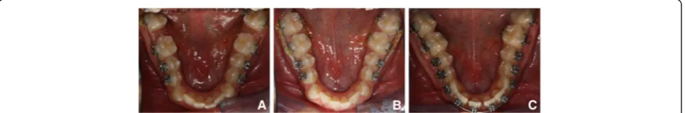 Figure 3 Pretreatment photographs after third molar extractions.