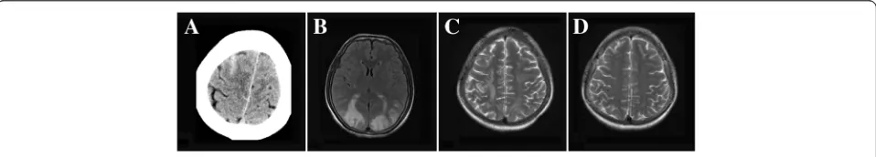 Figure 1 Brain imaging in RCVS. (A) CT scan showing cSAH; (B) FLAIR showing bilateral hypersignals in the occipital lobes consistent with PRES;(C,D) MRI showing right hyperintense subcortical lesions consistent with vasogenic edema and right brain hemorrhage;and cranial MRI showingresolution of the lesion after 12 weeks from the same patient as shown in C.
