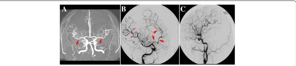 Figure 2 Vascular imaging in RCVS.angiography showing multiple narrowing and dilatations of middle cerebral artery (thin red arrow) and anterior cerebral artery (thick red arrow);(C) (A) MRA showing the multiple narrowings of bilateral middle cerebral artery (red arrow); (B) cerebral follow up angiography showing resolution of cerebral vasoconstriction after treatment from the same patient.