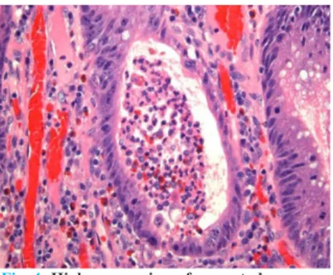 Fig. 3: High-power view of a crypt abscess  shows the crypt to be dilated and filled with  neutrophils and debris.