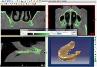 Figure 1: The three-dimensional view of the bone by the Mimics 10.01 software