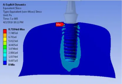 Figure 7: The distribution pattern and place of maximum stress on the trabecular bone in the second group