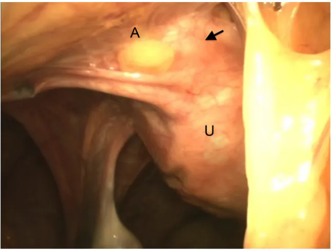 Figure 1 Laparoscopic view of ventrofixed uterus in a case who underwent LAVH.Notes: arrow shows site of scarring