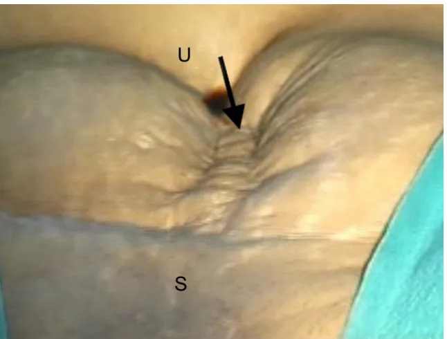 Figure 2 Laparoscopic view of ventrofixed uterus of another case who underwent LAVH.Notes: arrow shows site of scarring