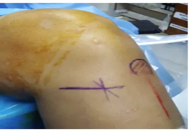 Figure 1. Vertical Incision.