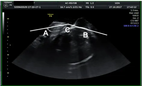 Figure 1 sHD is measured by drawing a line through the symphysis (A) and from the end of the symphysis a second line perpendicular to the fetal skull (B); the last line is the sHD.Abbreviation: sHD, symphysis–head distance.