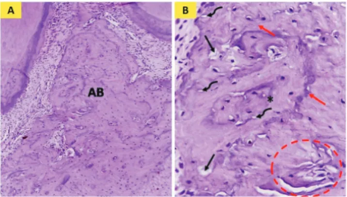 Fig. 2. Photomicrograph of group 2: (A) showing interdental alveolar bone  (AB), (B) showing bone trabeculae (bt) containing reversal lines (black  arrows) and Howship’s lacuna (red arrows) (A: H&amp;E ×100, B: H&amp;E ×400)