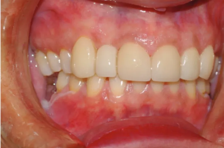Fig. 1. Maxillary anterior teeth with gingival recession and discoloration
