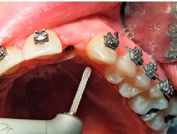 Fig. 2. Intraoral view of the emergence profile of the implant in position 22